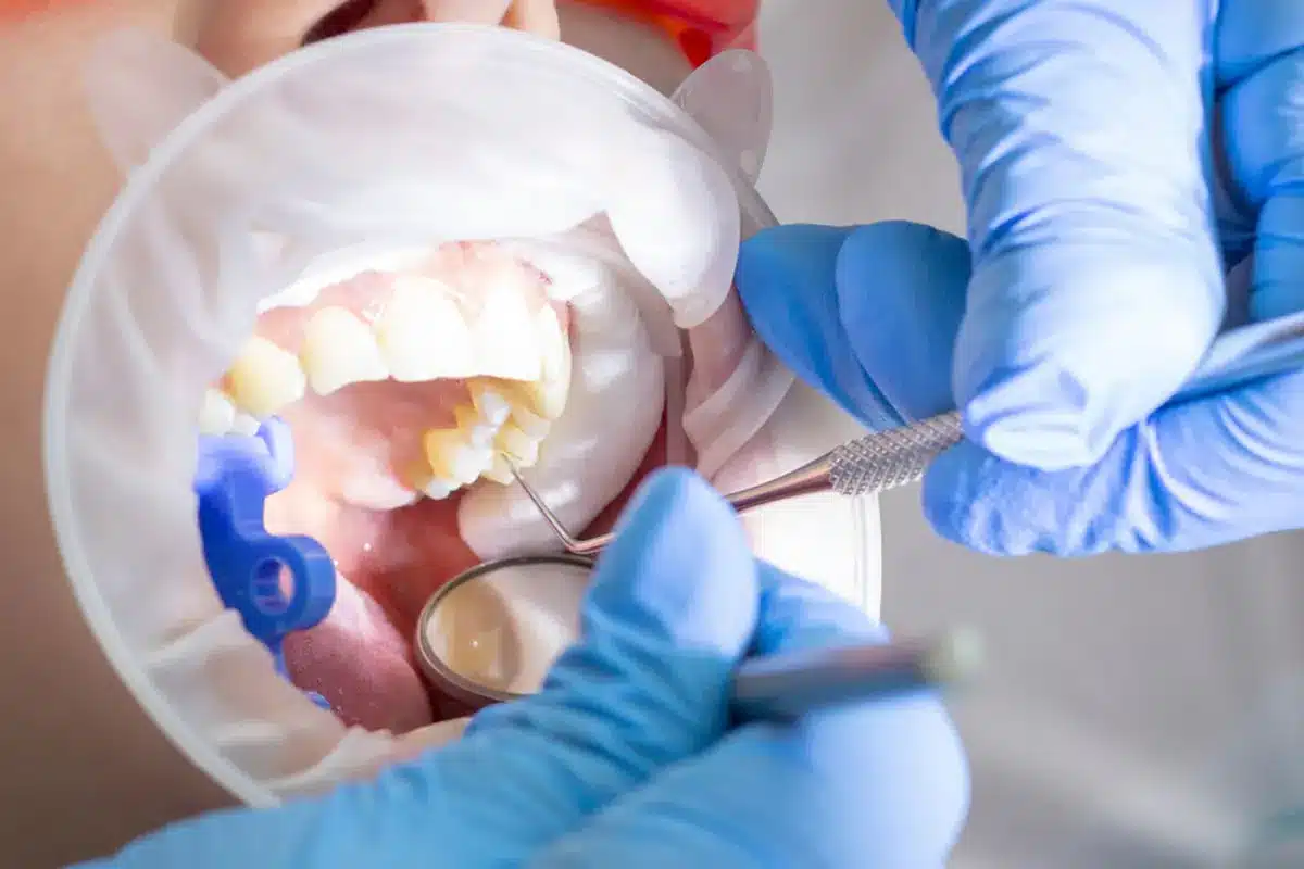 A dentist performing a painless root canal treatment on a patient at Esthetic Edge Dental Clinic Jammu, showing the patient’s open mouth and dental instruments in the doctor’s hands