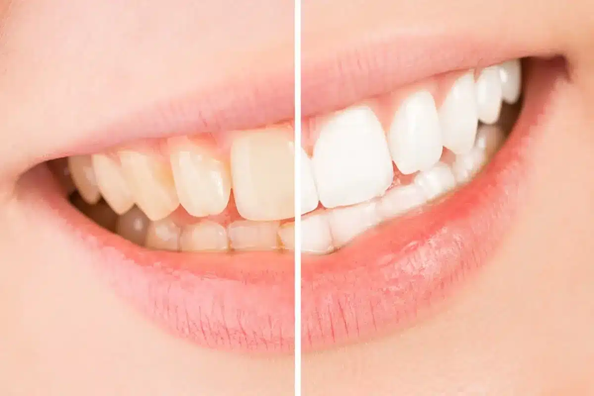 teeth whitening before and after results of a woman